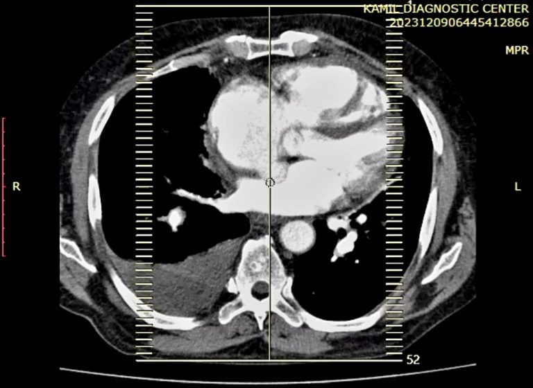 The Role of Imaging in the Diagnosis and Management of Pulmonary Embolism